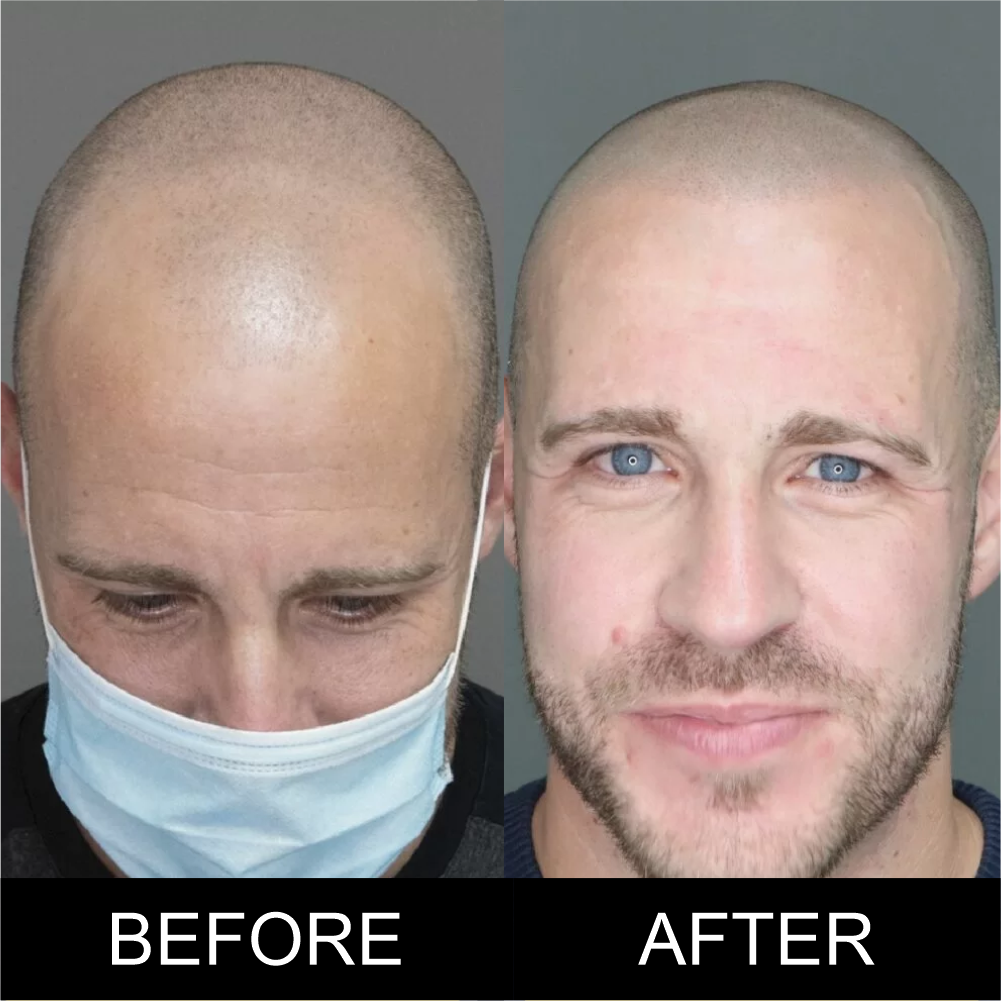 Permanent Makeup Professional Workshop - Piotr treatment - SMP